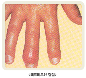 헤르베르덴 결절 사진