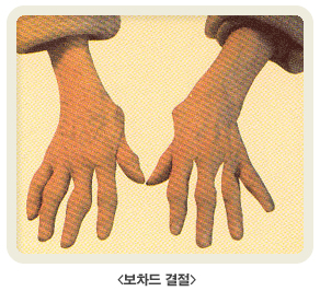 보차드 결절 사진